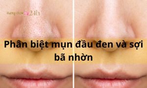 Phân biệt mụn đầu đen và sợi bã nhờn